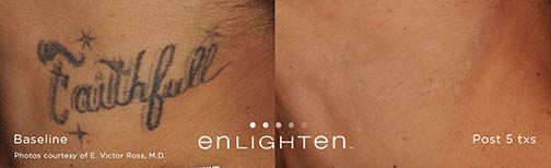 enlighten - Tattoo Removal