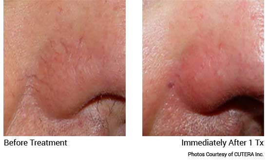 xeo Before & After