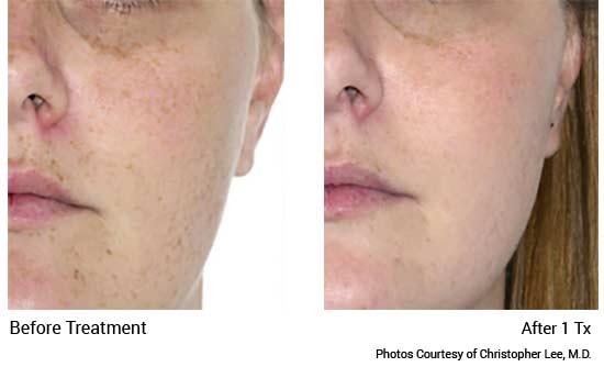 xeo Before & After