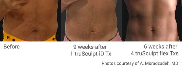 truSculpt id & flex combined treatments