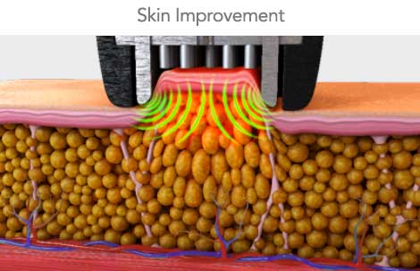 skin improvement with radio frequency device