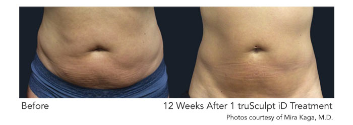 truSculpt iD fat reduction before and after