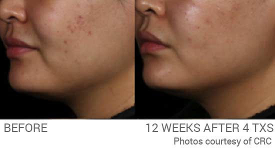 Acne scars before and after photos