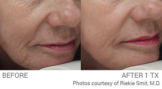 PICo Genesis Fx wrinkle reduction before and after