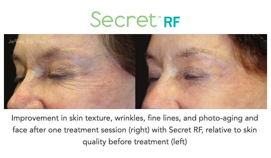 Secret RF before and after treatment