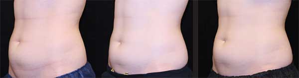 truSculpt iD and flex treatments