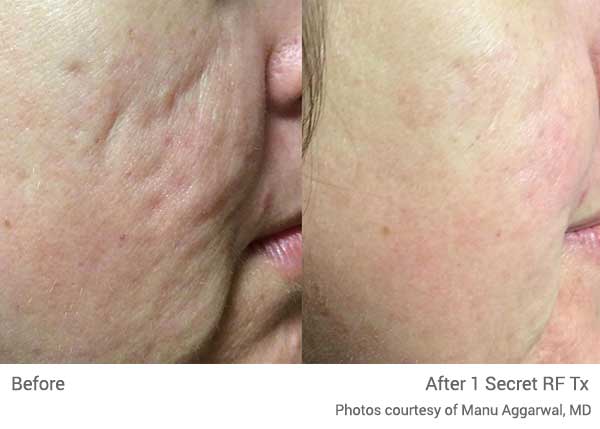 Secret RF Acne Scar Treatment
